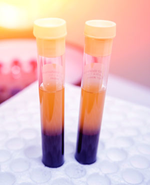 Patient Samples Patient Samples