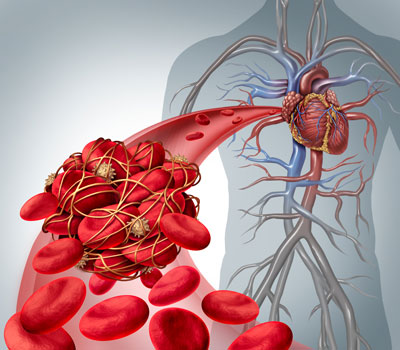 Thrombosis Proteins Thrombosis Proteins